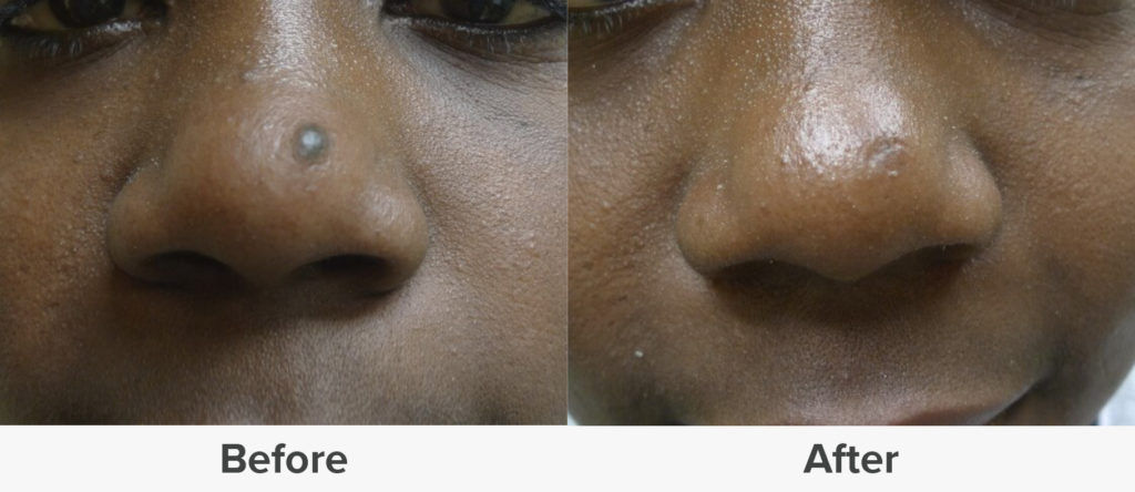 laser-moles-removal-lagos-daisy-signature-aesthetics